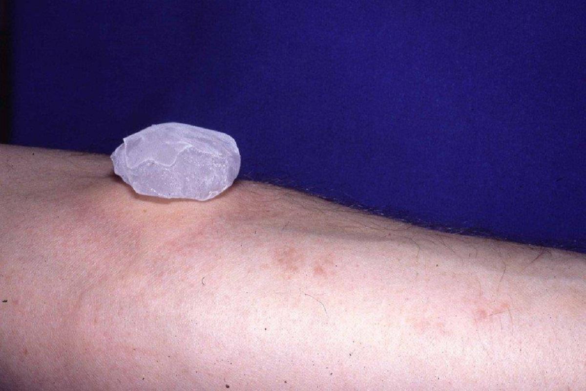 L'urticaire au froid est un autre type de cette pathologie.