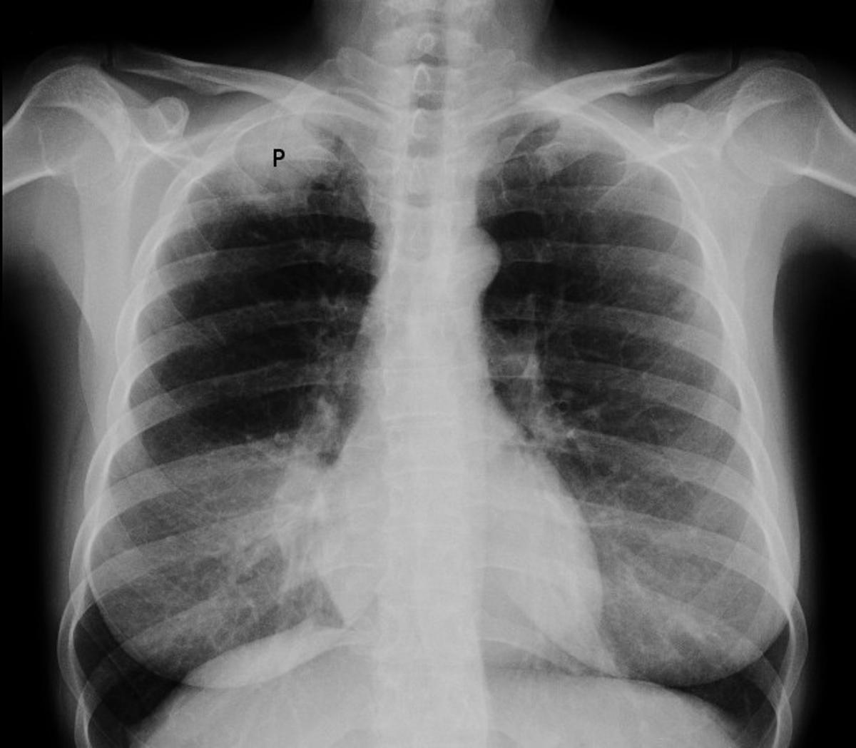 Radiographie pulmonaire montrant une tumeur de Pancoast chez une fumeuse de 47 ans