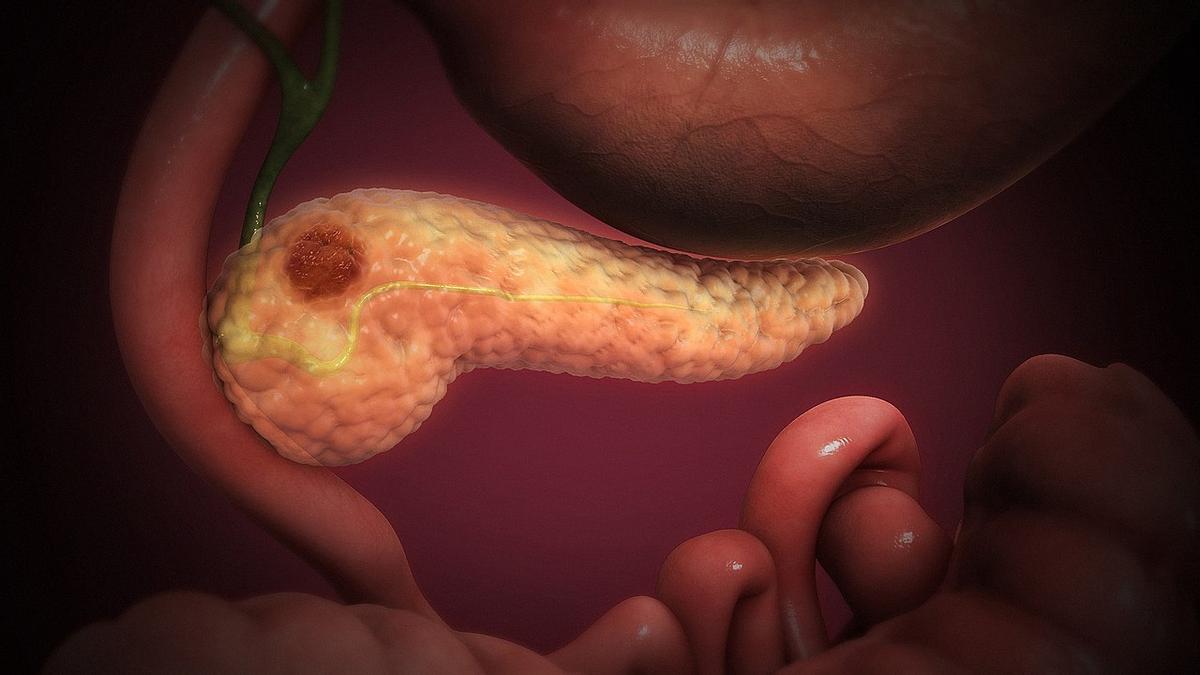 Pancréas Cancer: images de cellules cancéreuses formant une bosse dans le tissu pancréatique.