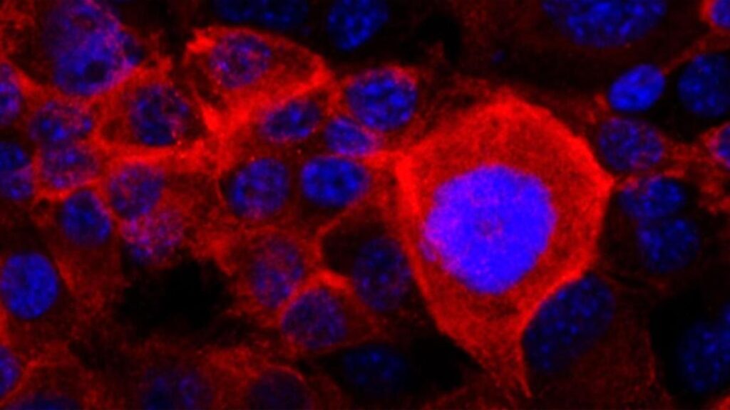 El cáncer de páncreas es difícil de diagnosticar porque son los síntomas son inespecíficos