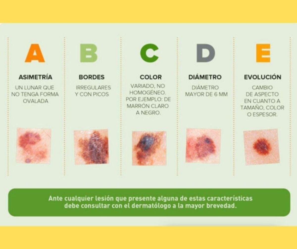 Règle ABCDE pour détecter les mélanomes