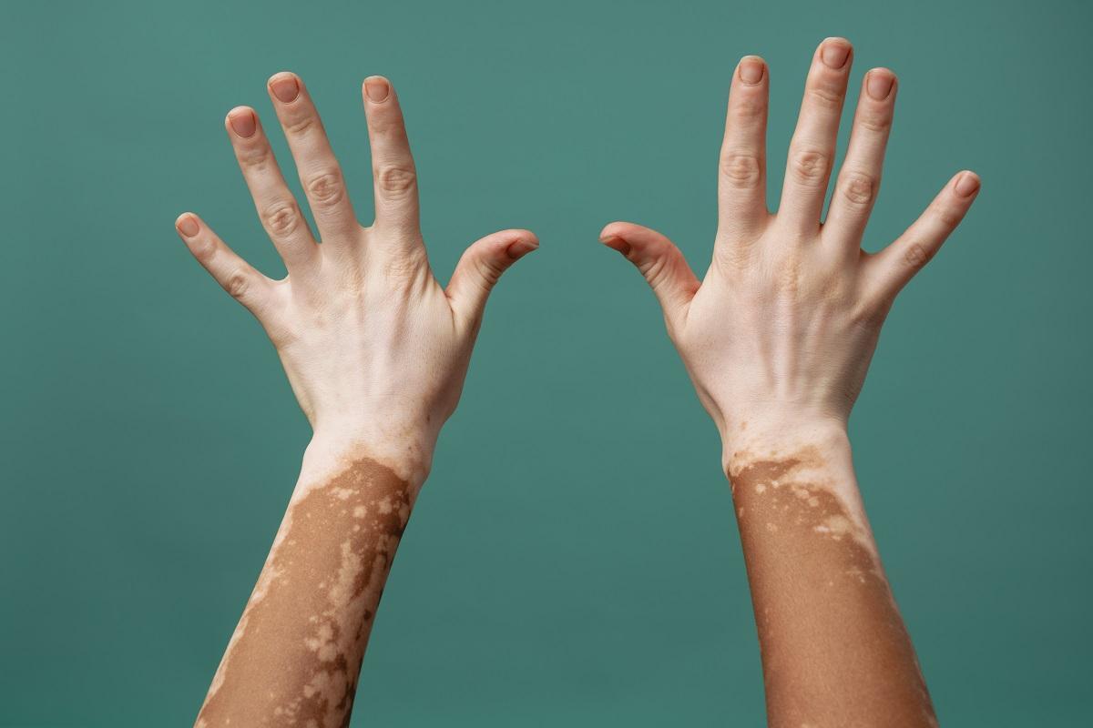 Le soleil augmente les taches causées par le vitiligo.