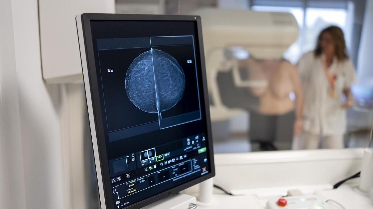 En Espagne, environ 35 312 nouveaux cancers du sein ont été diagnostiqués en 2023