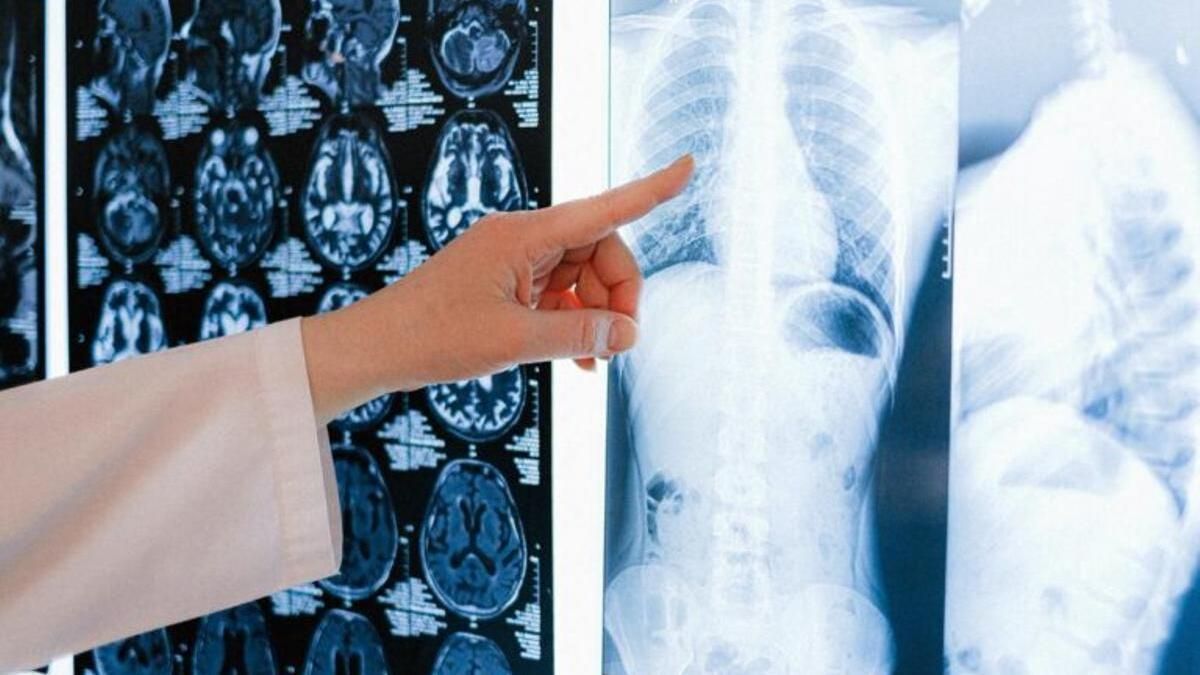 Cancer du Poumon, La Tumeur Maligne Avec L'Incidence la Plus Élevée