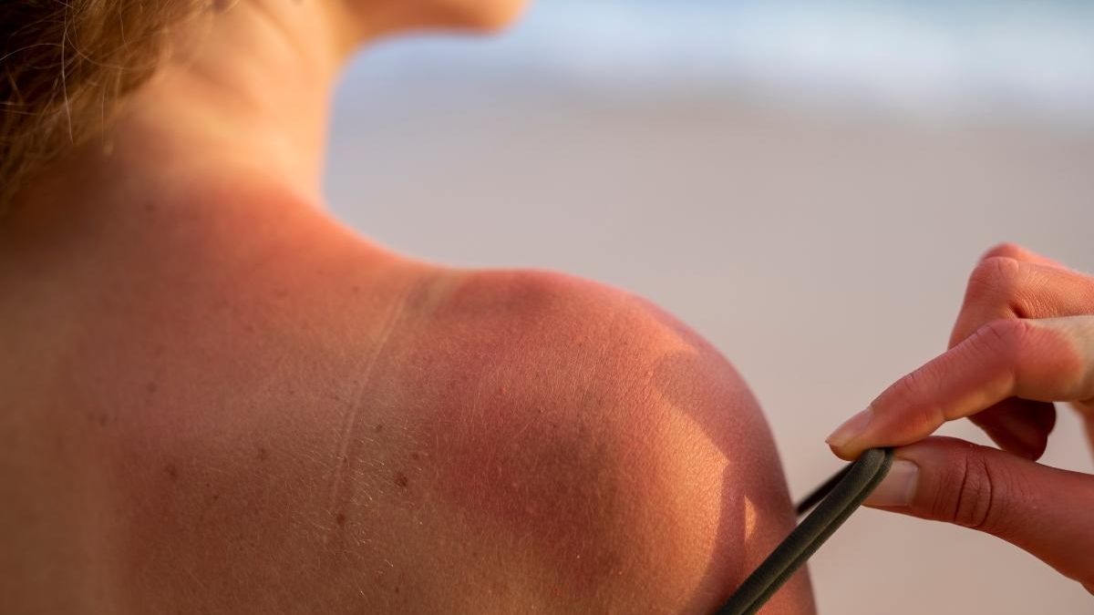 Las quemaduras solares aumentan el riesgo de padecer cáncer de piel