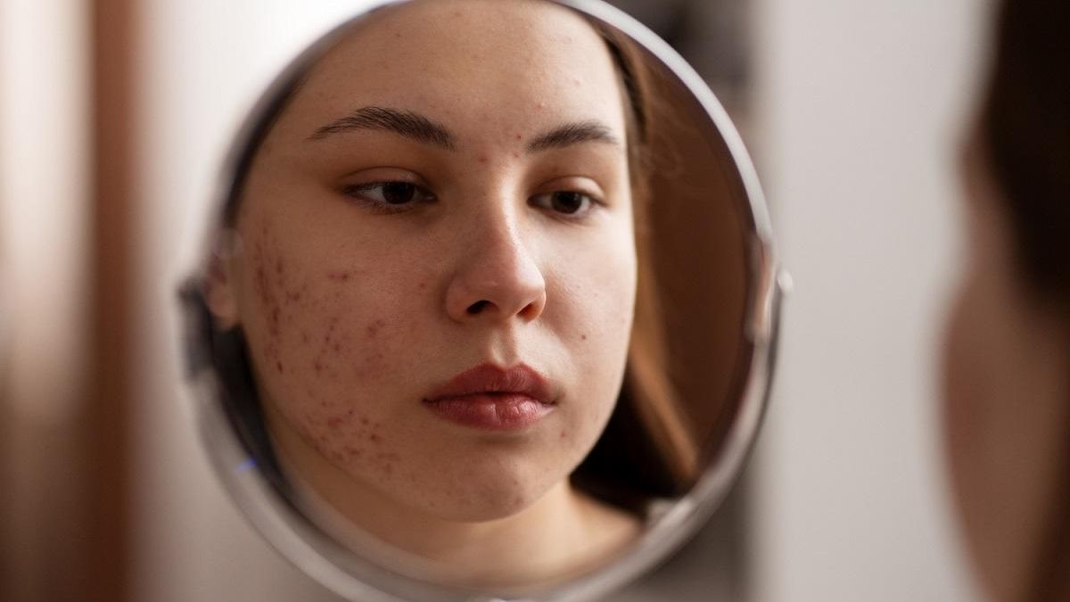Las personas con acné deben usar fotoprotector específico durante el verano
