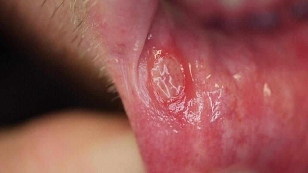 Ante cualquier llaga que no cicatrice, mancha o bulto en la boca, se debe acudir a un especialista